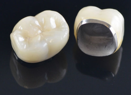Porcelain fused metal crowns and dental implant cap at AMD 