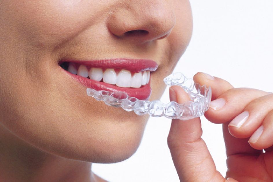 Things about Clear Aligners You Wish You Knew Before Investing 
