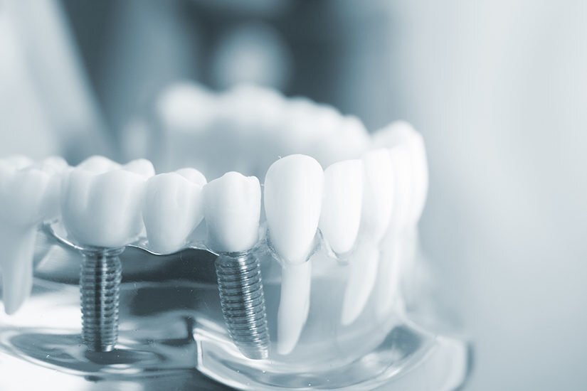 Why are Dental Implants and Dental Crowns so Expensive? 