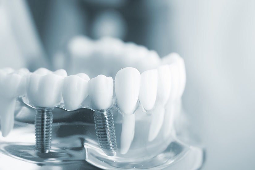 why are dental crowns so expensive Why are Dental Crowns So Expensive? Unveiling Costs