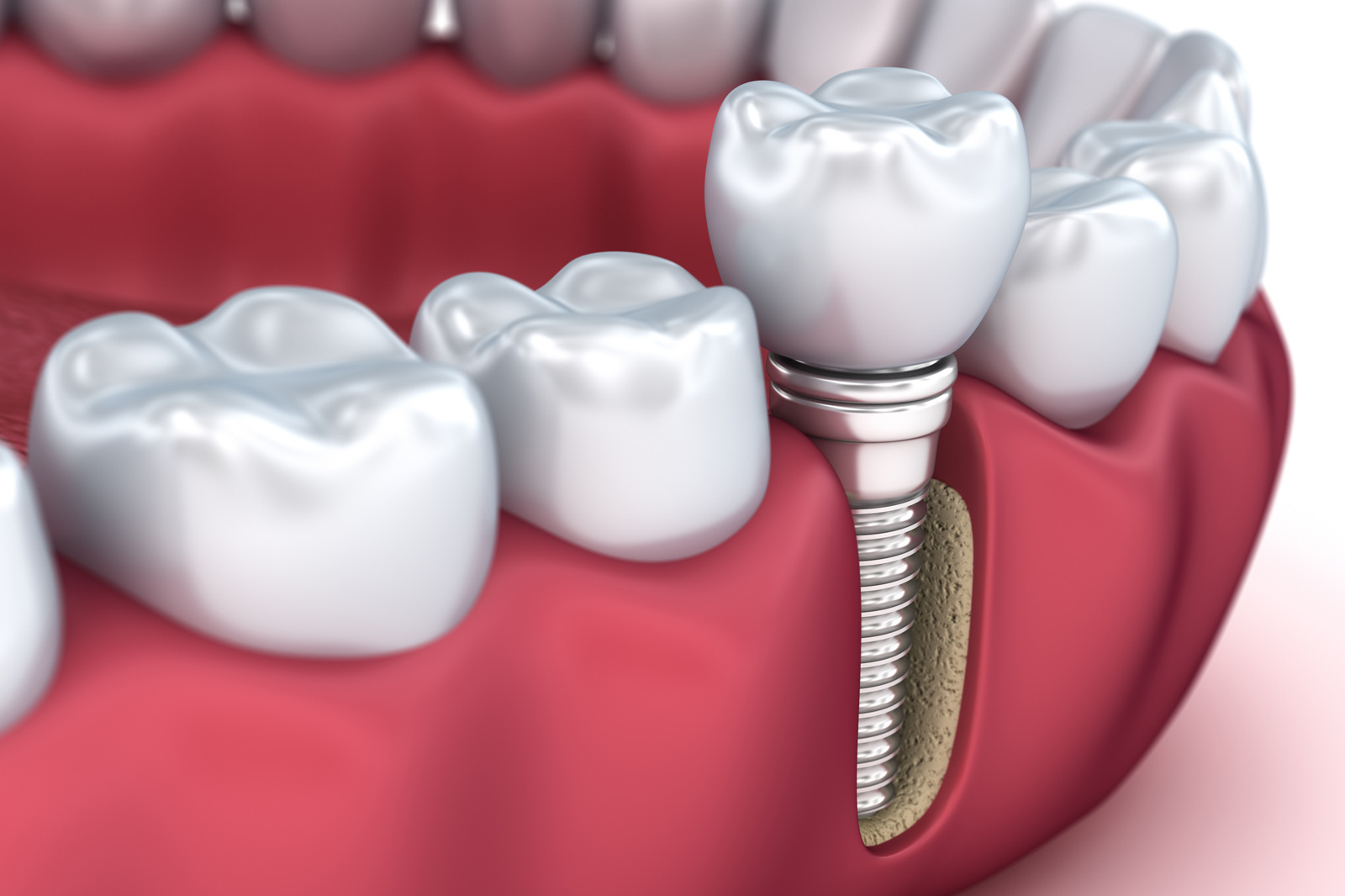 Dental Implants - Procedure, Advantages and Cost