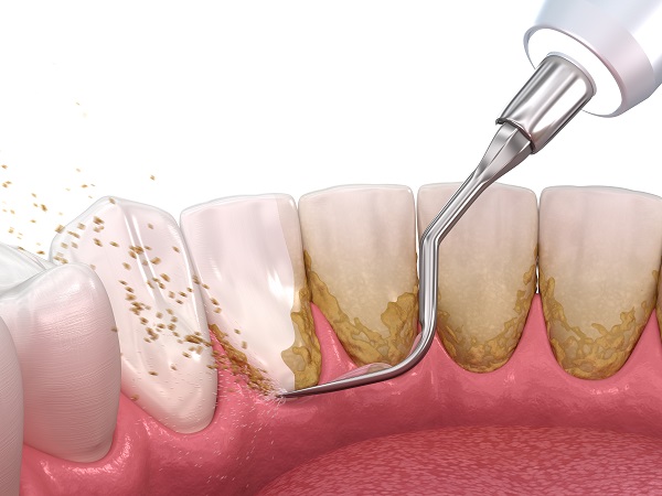 does teeth cleaning lead to loosening of teeth? 