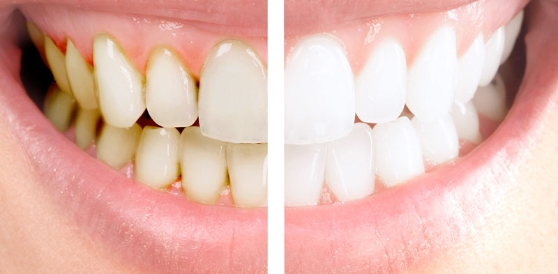 Exploring the Causes and Treatments of Tooth Stains 