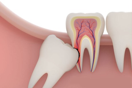Wisdom teeth: a complete guide about the problems and care.