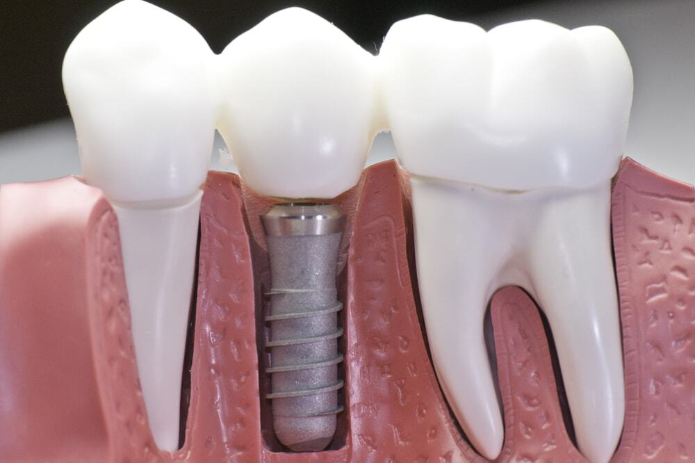 what is dental implant and its process? 