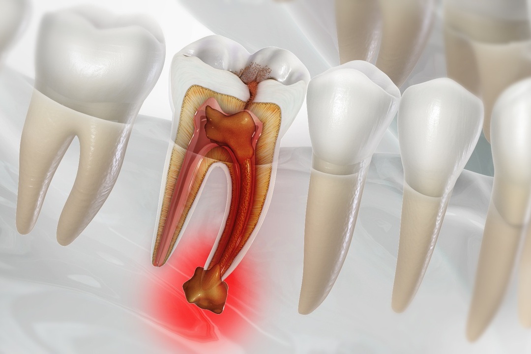 Every thing you need to know about tooth infections