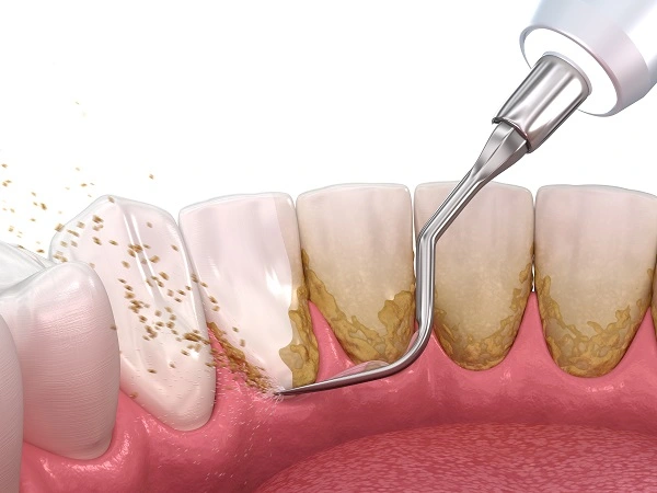 does teeth cleaning lead to loosening of teeth? does teeth cleaning lead to loosening of teeth?