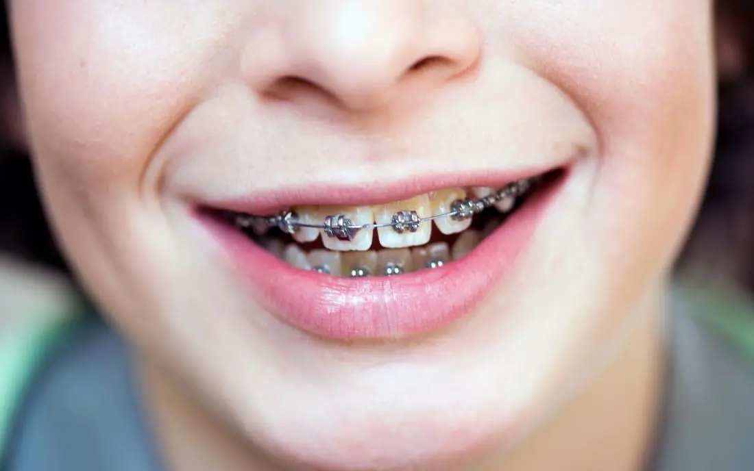Detailed analysis of cost of metal braces in India Detailed analysis of cost of metal braces in India