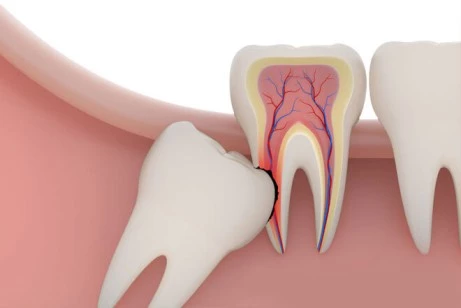 Wisdom Tooth Extraction Treatment - Everything You Need To Know Wisdom Tooth Extraction Treatment - Everything You Need To Know