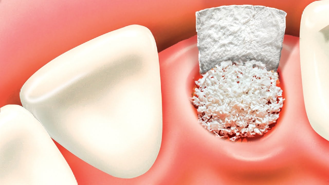 Bone grafting treatment in Jaipur at AMD Dental Clinic 