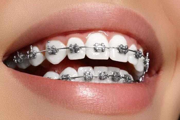 Metal and Ceramic dental braces for maligned teeth 